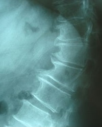 Cervical spondylosis